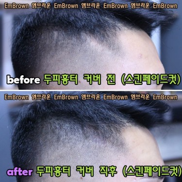 두피흉터(땜통) 커버문신