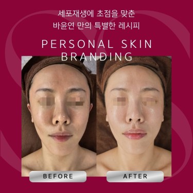 슈퍼젝션윤곽리프팅 1+1 