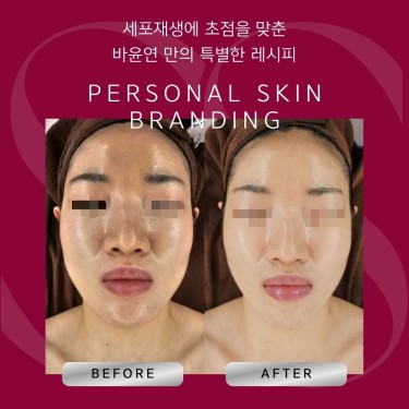 피부도로공사 민낯소생술