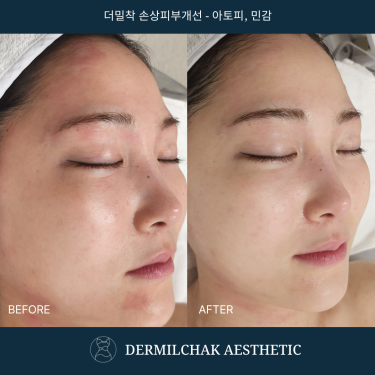 피부균형단계 - 빌드스킨