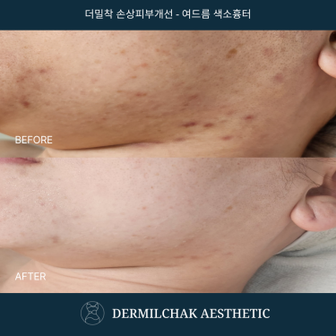 피부균형단계 - 아크네리셀